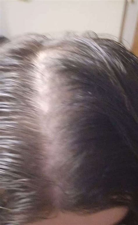 rogin e reddit|Minoxidil FAQs : r/minoxidil .